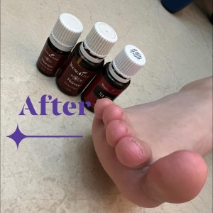 腳趾脫皮好困擾?